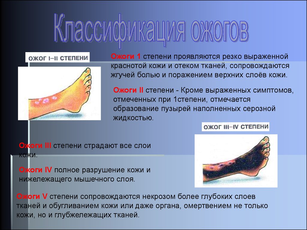 Признаки второй степени термического ожога